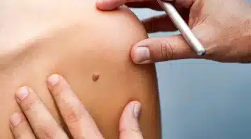 احذر علامات مبكرة الجلد قد تشير إلى الإصابة بالسرطان لا تتجاهلها