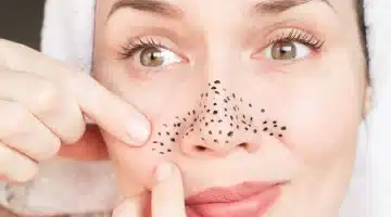 الخلطة السرية ودعي الرؤوس السوداء في الأنف إلى الأبد بخطوات منزلية مذهلة 1