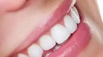 تبيض الأسنان بالفحم وقشر الموز وصفات طبيعية لأسنان ناصعة البياض 1