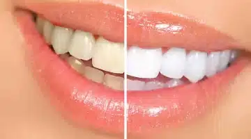وصفة سحرية لتبييض الأسنان في 5 دقائق . حلول طبيعية للاصفرار العميق 1